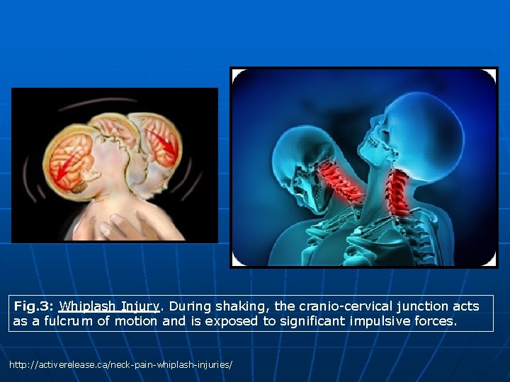 Fig. 3: Whiplash Injury. During shaking, the cranio-cervical junction acts as a fulcrum of