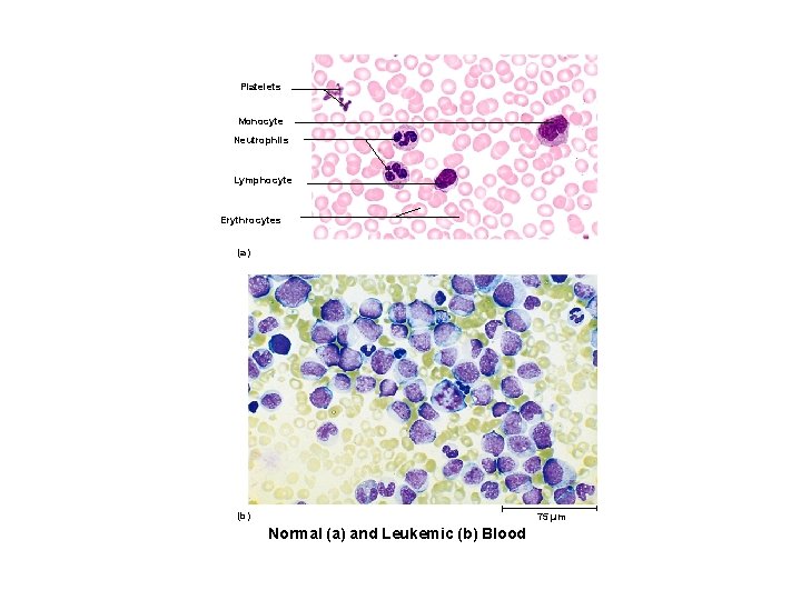 Platelets Monocyte Neutrophils Lymphocyte Erythrocytes (a) (b) 75 µm Normal (a) and Leukemic (b)