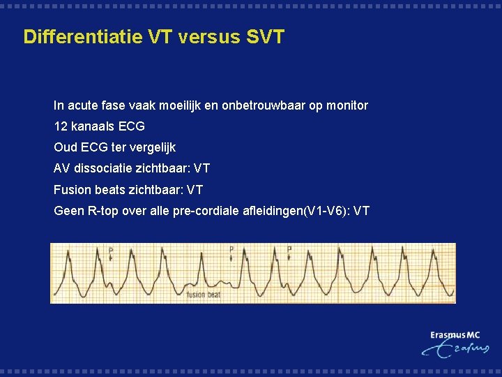Differentiatie VT versus SVT § In acute fase vaak moeilijk en onbetrouwbaar op monitor