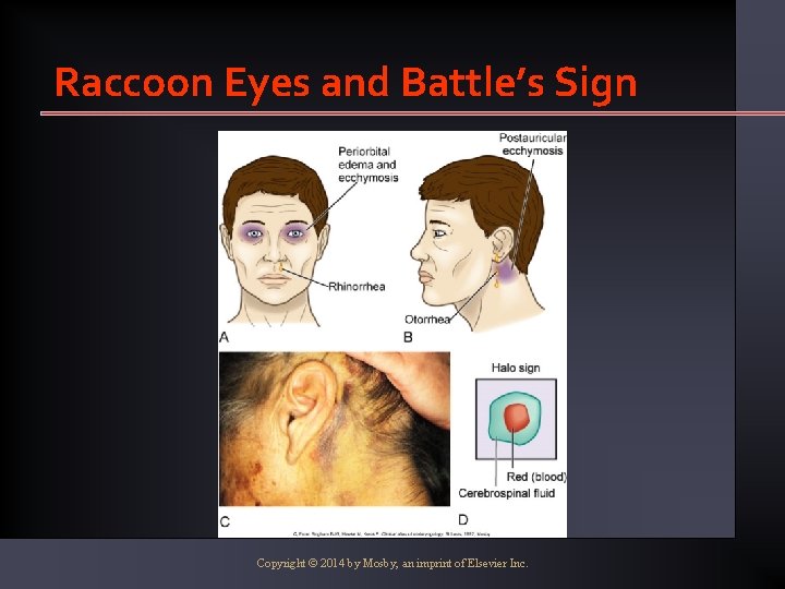 Raccoon Eyes and Battle’s Sign Copyright © 2014 by Mosby, an imprint of Elsevier