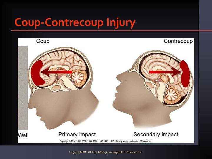 Coup-Contrecoup Injury Copyright © 2014 by Mosby, an imprint of Elsevier Inc. 