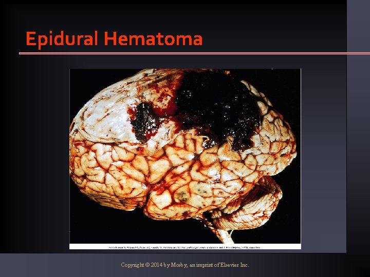 Epidural Hematoma Copyright © 2014 by Mosby, an imprint of Elsevier Inc. 