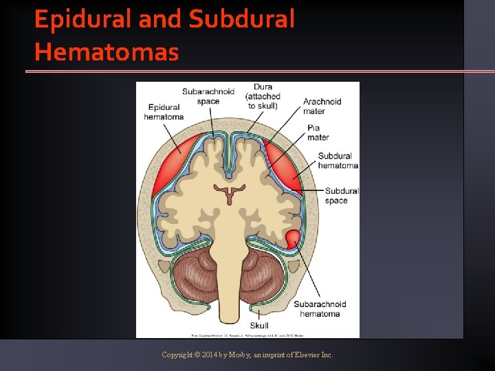 Epidural and Subdural Hematomas Copyright © 2014 by Mosby, an imprint of Elsevier Inc.