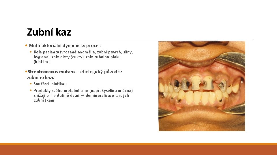 Zubní kaz • Multifaktoriální dynamický proces • Role pacienta (vrozené anomálie, zubní povrch, sliny,