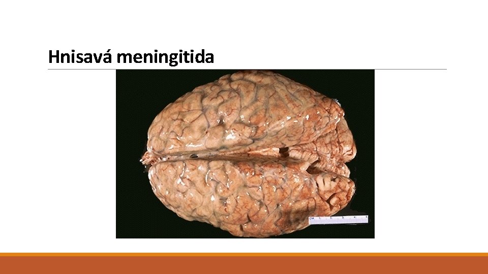 Hnisavá meningitida 