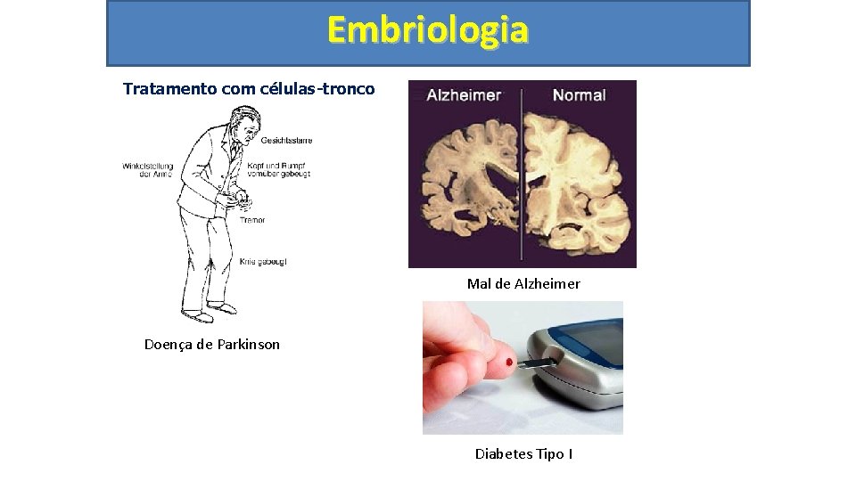 Embriologia Tratamento com células-tronco Mal de Alzheimer Doença de Parkinson Diabetes Tipo I 