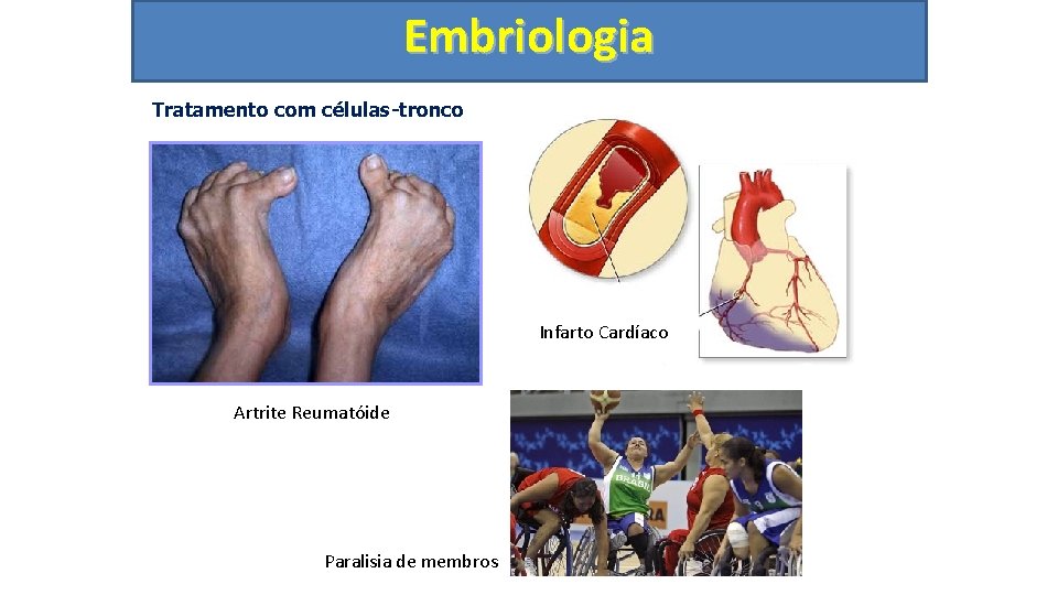Embriologia Tratamento com células-tronco Infarto Cardíaco Mal de Alzheimer Artrite Reumatóide Paralisia de membros