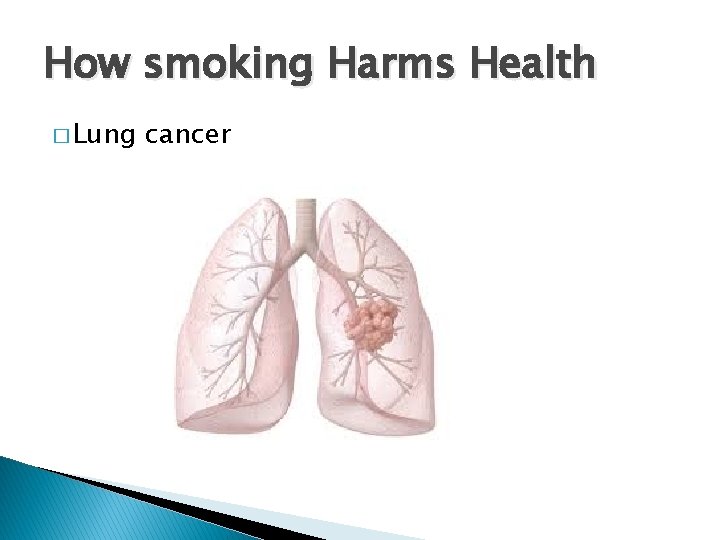 How smoking Harms Health � Lung cancer 