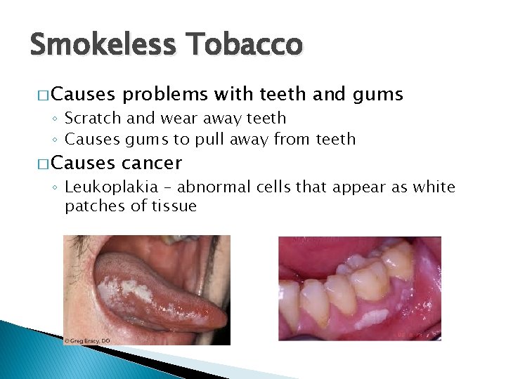 Smokeless Tobacco � Causes problems with teeth and gums � Causes cancer ◦ Scratch