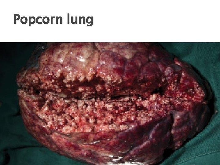 Popcorn lung 