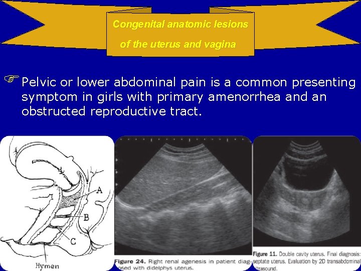 Congenital anatomic lesions of the uterus and vagina Pelvic or lower abdominal pain is