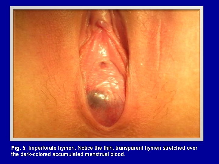 Fig. 5 Imperforate hymen. Notice thin, transparent hymen stretched over the dark-colored accumulated menstrual