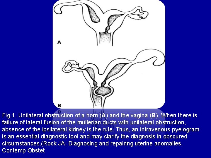 Fig. 1. Unilateral obstruction of a horn (A) and the vagina (B). When there