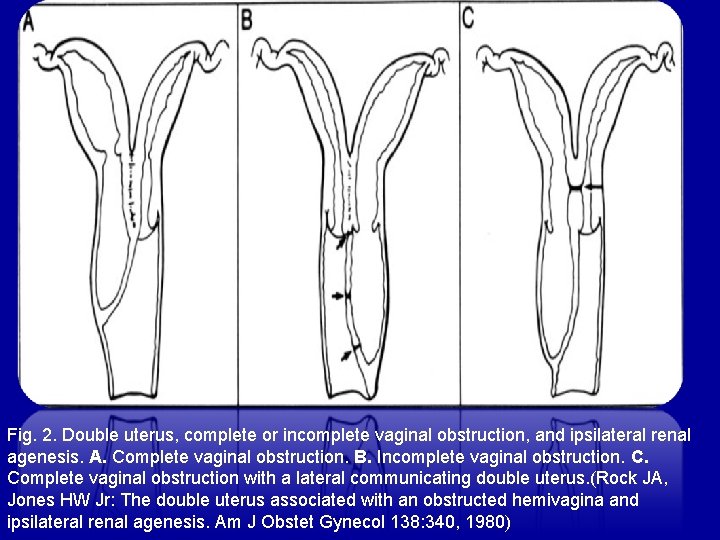 Fig. 2. Double uterus, complete or incomplete vaginal obstruction, and ipsilateral renal agenesis. A.