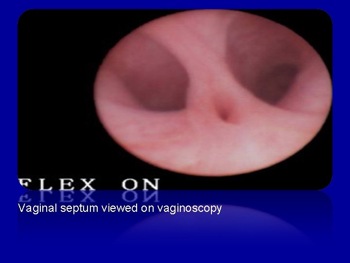 Vaginal septum viewed on vaginoscopy 