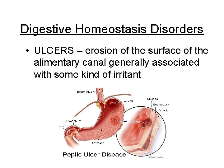 Digestive Homeostasis Disorders • ULCERS – erosion of the surface of the alimentary canal