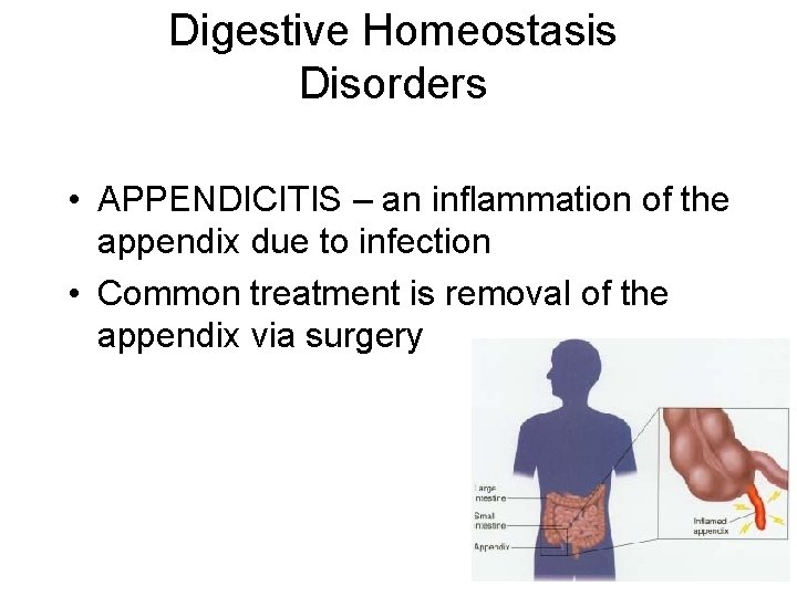 Digestive Homeostasis Disorders • APPENDICITIS – an inflammation of the appendix due to infection