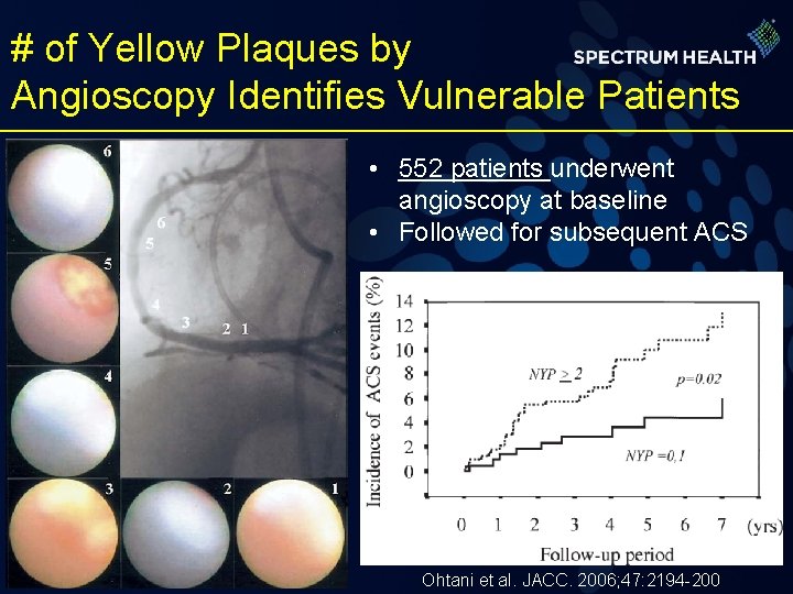 # of Yellow Plaques by Angioscopy Identifies Vulnerable Patients • 552 patients underwent angioscopy
