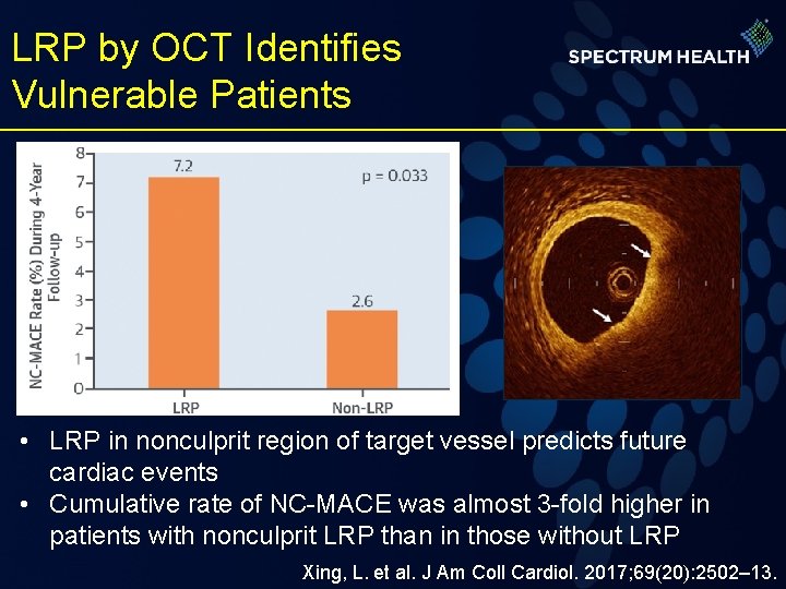 LRP by OCT Identifies Vulnerable Patients • LRP in nonculprit region of target vessel