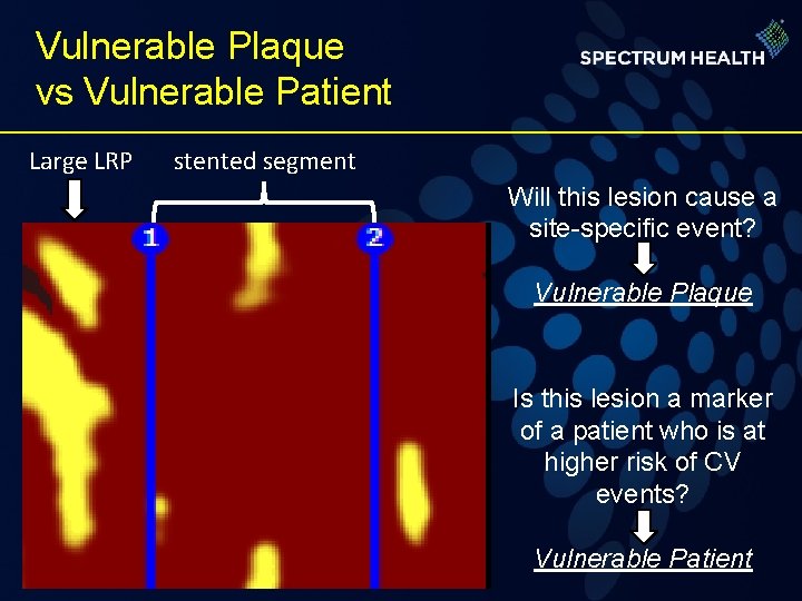 Vulnerable Plaque vs Vulnerable Patient Large LRP stented segment Will this lesion cause a