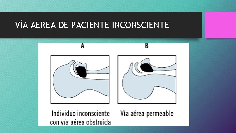VÍA AEREA DE PACIENTE INCONSCIENTE 