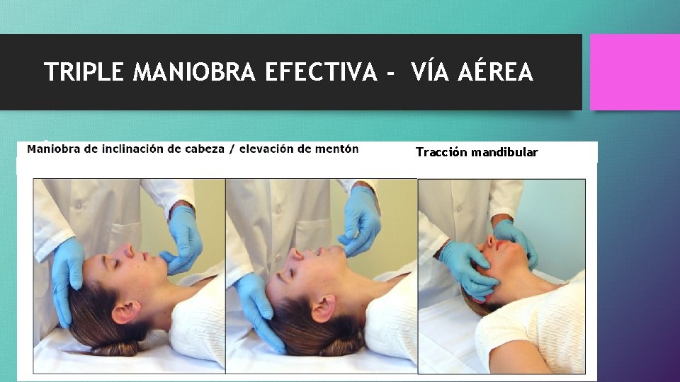 TRIPLE MANIOBRA EFECTIVA - VÍA AÉREA • Tracción mandibular 