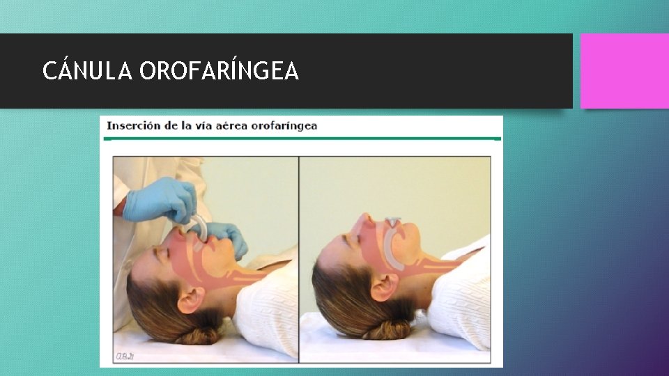 CÁNULA OROFARÍNGEA 