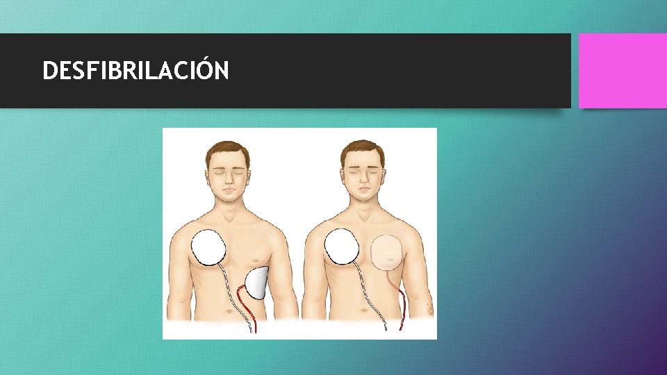 DESFIBRILACIÓN 