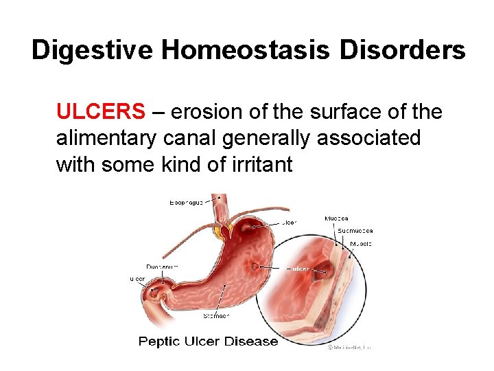 Digestive Homeostasis Disorders ULCERS – erosion of the surface of the alimentary canal generally