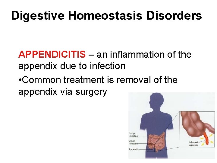 Digestive Homeostasis Disorders APPENDICITIS – an inflammation of the appendix due to infection •