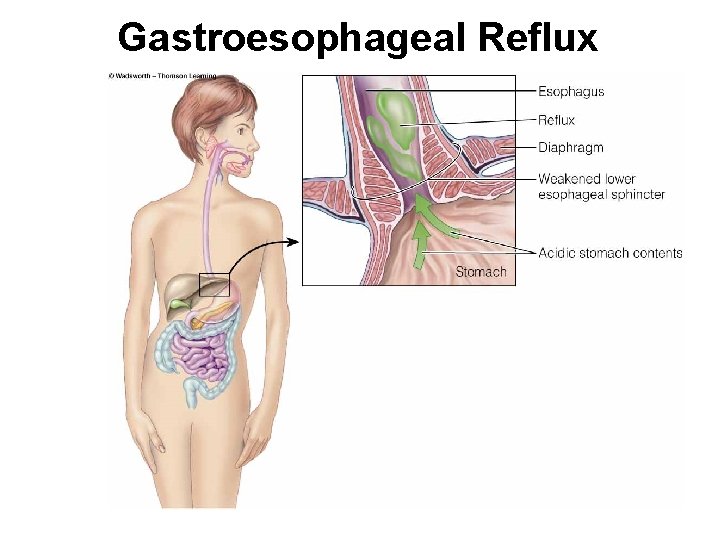 Gastroesophageal Reflux 