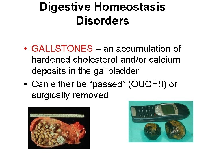 Digestive Homeostasis Disorders • GALLSTONES – an accumulation of hardened cholesterol and/or calcium deposits