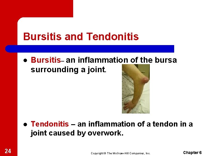 Bursitis and Tendonitis 24 l Bursitis– an inflammation of the bursa surrounding a joint. Bursitis and Tendonitis 24 l Bursitis– an inflammation of the bursa surrounding a joint.