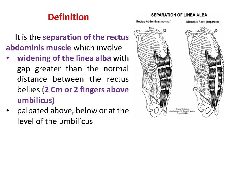  Definition It is the separation of the rectus abdominis muscle which involve •