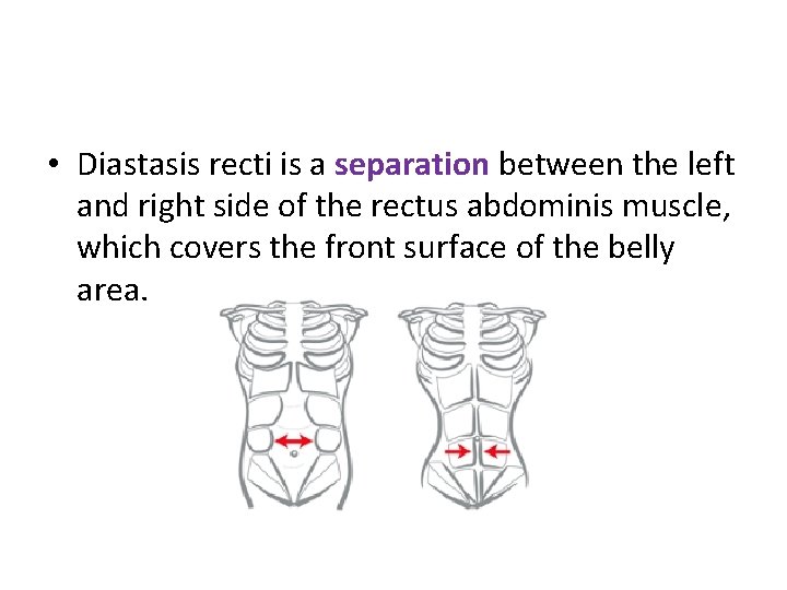 • Diastasis recti is a separation between the left and right side of