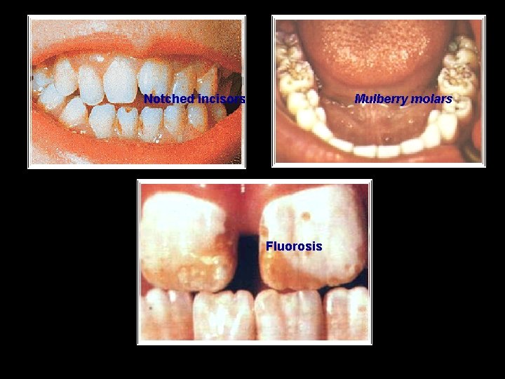 Notched incisors Mulberry molars Fluorosis 