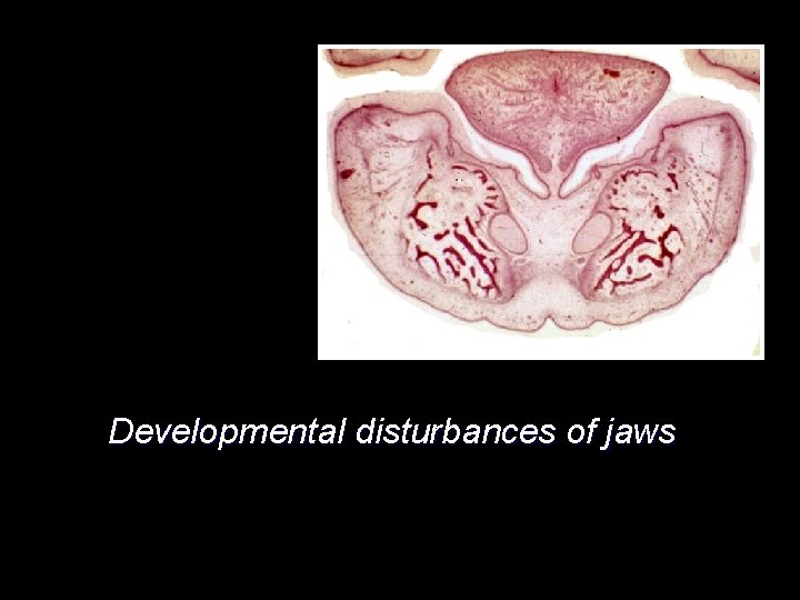  Developmental disturbances of jaws 