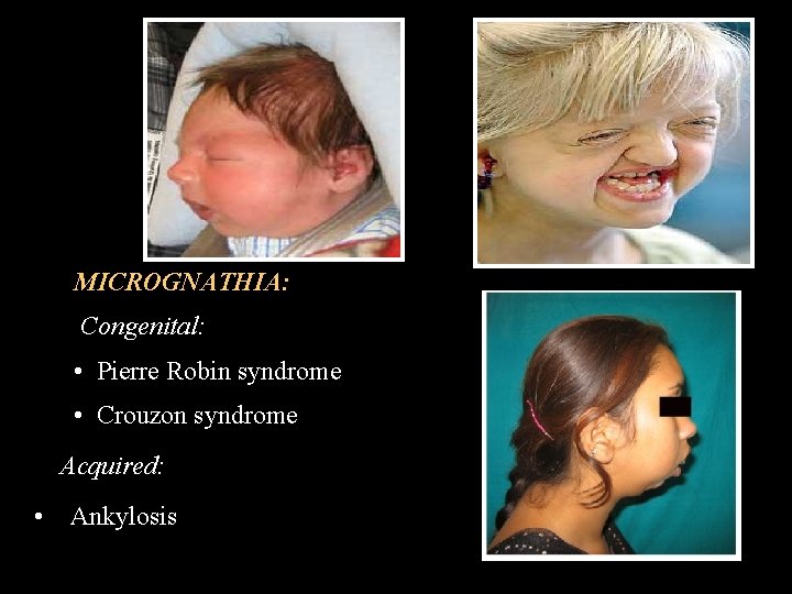 MICROGNATHIA: Congenital: • Pierre Robin syndrome • Crouzon syndrome Acquired: • Ankylosis 