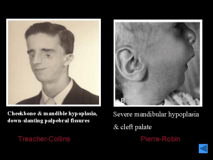 Cheekbone & mandible hypoplasia, down-slanting palpebral fissures Treacher-Collins Severe mandibular hypoplasia & cleft palate