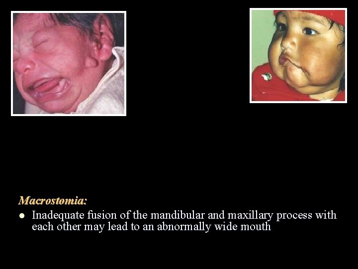 Macrostomia: l Inadequate fusion of the mandibular and maxillary process with each other may