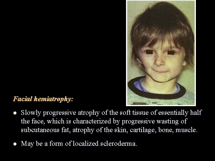 Facial hemiatrophy: l Slowly progressive atrophy of the soft tissue of essentially half the