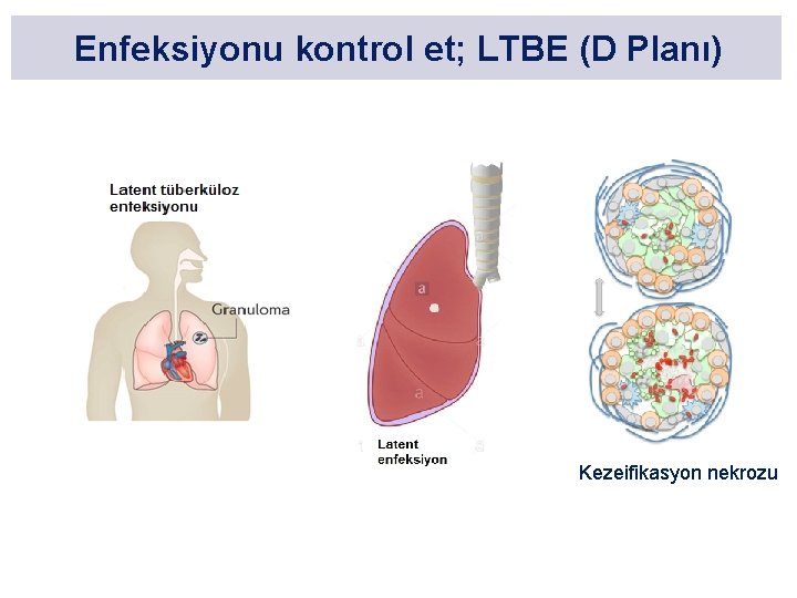 Enfeksiyonu kontrol et; LTBE (D Planı) Kezeifikasyon nekrozu 