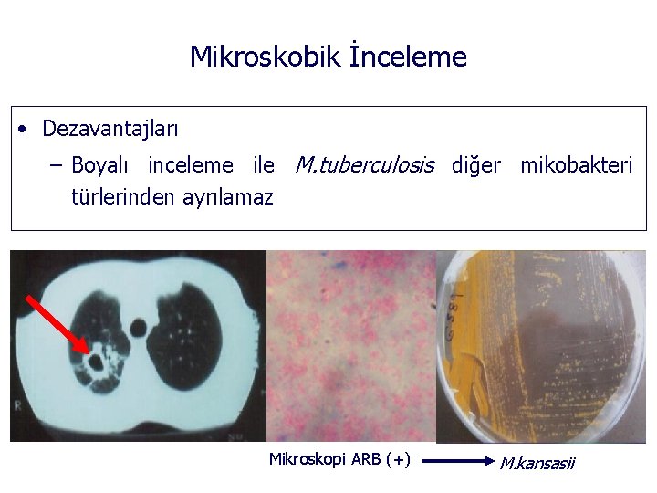 Mikroskobik İnceleme • Dezavantajları – Boyalı inceleme ile M. tuberculosis diğer mikobakteri türlerinden ayrılamaz