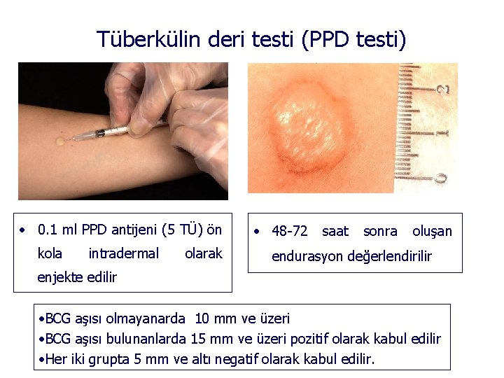 Tüberkülin deri testi (PPD testi) • 0. 1 ml PPD antijeni (5 TÜ) ön