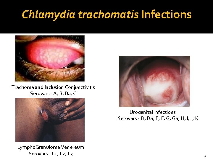 Chlamydia trachomatis Infections Trachoma and Inclusion Conjunctivitis Serovars - A, B, Ba, C Urogenital