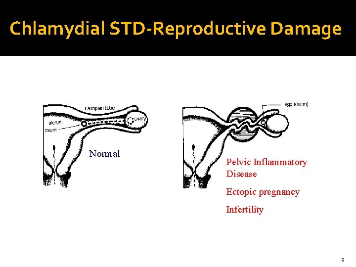 Chlamydial STD-Reproductive Damage Normal Pelvic Inflammatory Disease Ectopic pregnancy Infertility 9 