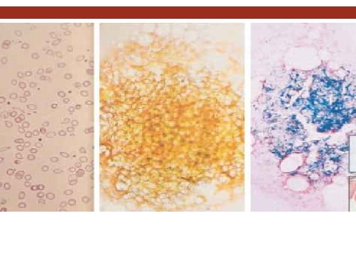Diagnosis. LABORATORY INVESTIGATIONS Bone marrow aspiration, with the marrow stained for iron Bone marrow
