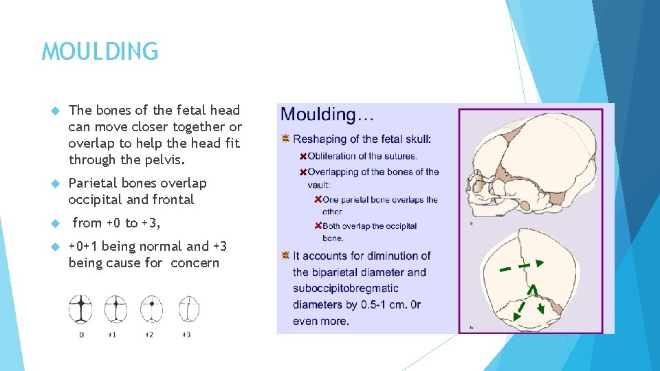 MOULDING The bones of the fetal head can move closer together or overlap to