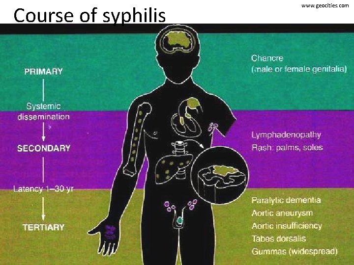 Course of syphilis www. geocities. com 