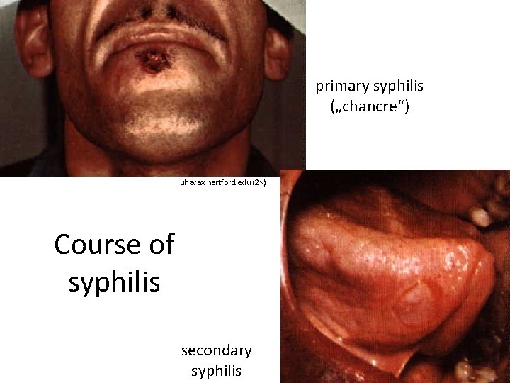 primary syphilis („chancre“) uhavax. hartford. edu (2×) Course of syphilis secondary syphilis 